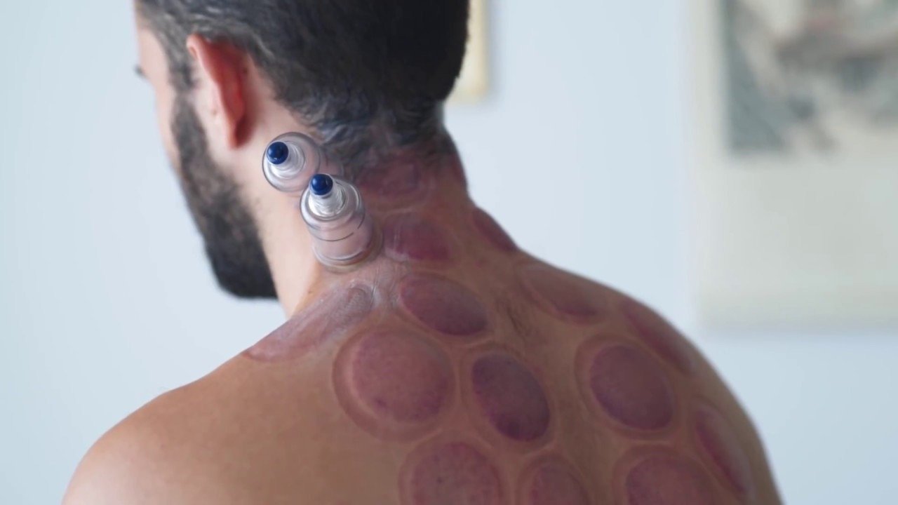 Unlocking Ancient Secrets: The Astonishing Health Benefits Of Hijama Cupping